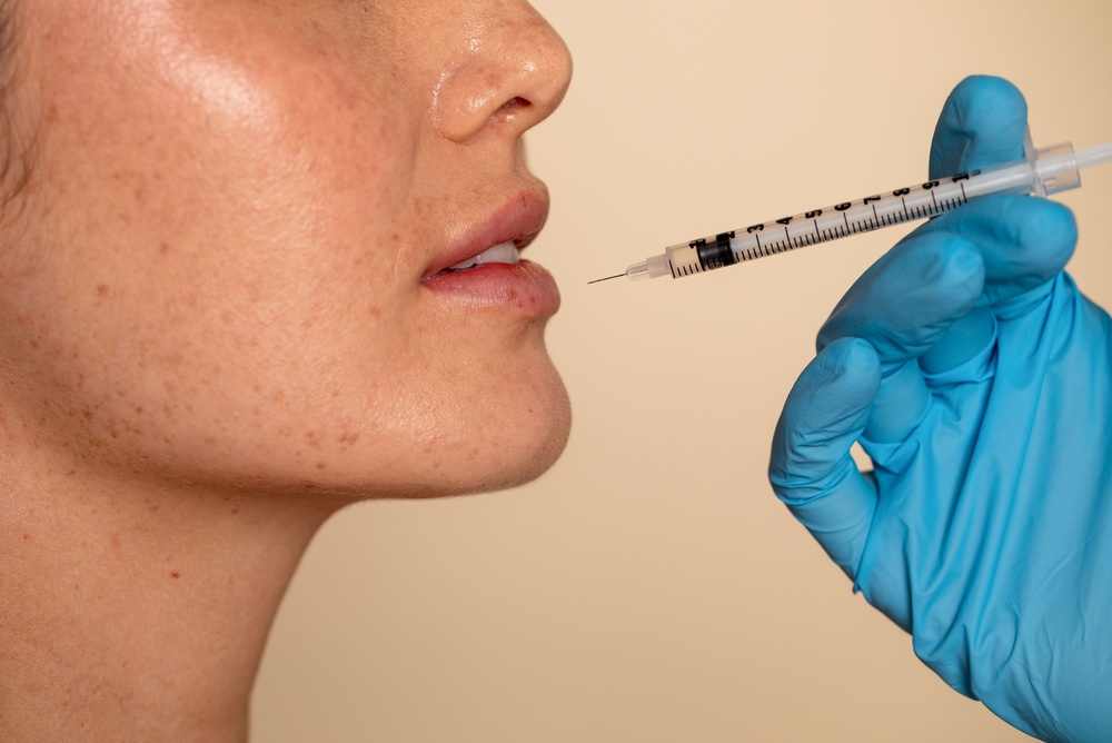 Lip Filler and Under Eye Rejuvenation Near Reston, Virginia