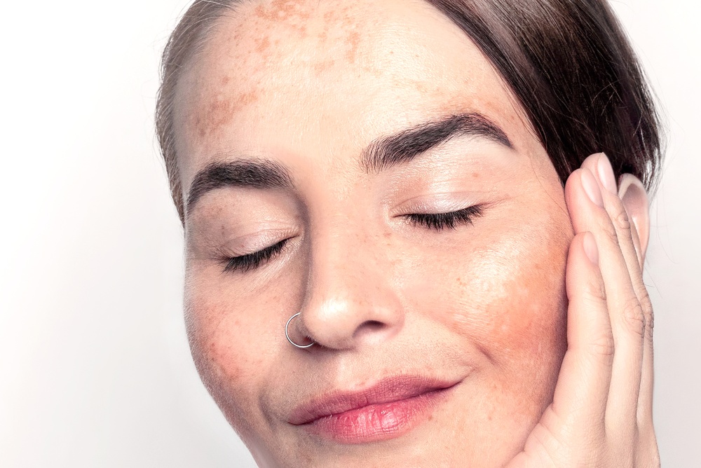 Pico Laser vs. Traditional Laser Treatments Near Vienna, Virginia: Which Is Better for Pigmentation and Sun Damage?