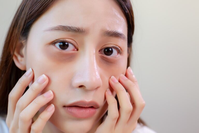 Under Eye Filler Treatments in Tysons, VA for Dark Circles and Hollow Eyes