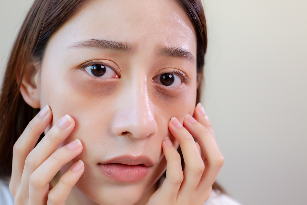 Under Eye Filler Treatments in Tysons, VA for Dark Circles and Hollow Eyes