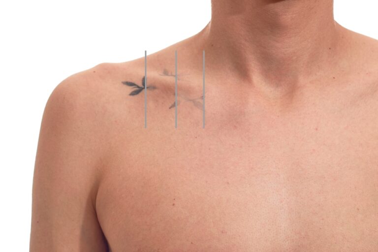 How Much Does Laser Tattoo Removal Cost in Reston VA?